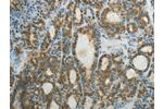 The image on the left is immunohistochemistry of paraffin-embedded Human thyroid cancer tissue using CSB-PA233120(CTSV Antibody) at dilution 1/50, on the right is treated with fusion protein. (Original magnification: 