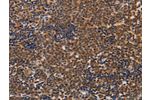 The image on the left is immunohistochemistry of paraffin-embedded Human lymphoma tissue using CSB-PA233146(ADH1A Antibody) at dilution 1/20, on the right is treated with fusion protein. (Original magnification: 