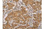 The image on the left is immunohistochemistry of paraffin-embedded Human gastic cancer tissue using CSB-PA233193(CDKN2A Antibody) at dilution 1/50, on the right is treated with synthetic peptide. (Original magnification: 