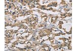 The image on the left is immunohistochemistry of paraffin-embedded Human thyroid cancer tissue using CSB-PA233244(CYR61 Antibody) at dilution 1/50, on the right is treated with fusion protein. (Original magnification: 