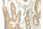 The image on the left is immunohistochemistry of paraffin-embedded Human colon cancer tissue using CSB-PA233398(ERG Antibody) at dilution 1/40, on the right is treated with fusion protein. (Original magnification: 