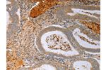 The image on the left is immunohistochemistry of paraffin-embedded Human cervical cancer tissue using CSB-PA233653(FOXN1  Antibody) at dilution 1/15, on the right is treated with synthetic peptide. (Original magnification: 