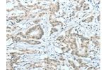 The image on the left is immunohistochemistry of paraffin-embedded Human colon cancer tissue using CSB-PA233816(ASH2L Antibody) at dilution 1/60, on the right is treated with fusion protein. (Original magnification: 
