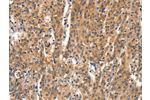 The image on the left is immunohistochemistry of paraffin-embedded Human gastic cancer tissue using CSB-PA234417(DEAF1 Antibody) at dilution 1/15, on the right is treated with synthetic peptide. (Original magnification: 