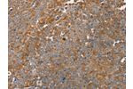 The image on the left is immunohistochemistry of paraffin-embedded Human ovarian cancer tissue using CSB-PA234848(FAIM2 Antibody) at dilution 1/30, on the right is treated with fusion protein. (Original magnification: 
