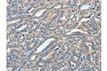 The image on the left is immunohistochemistry of paraffin-embedded Human thyroid cancer tissue using CSB-PA235182(ANGPT1 Antibody) at dilution 1/50, on the right is treated with fusion protein. (Original magnification: 