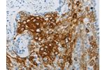 The image on the left is immunohistochemistry of paraffin-embedded Human cervical cancer tissue using CSB-PA235658(FLG Antibody) at dilution 1/30, on the right is treated with synthetic peptide. (Original magnification: 