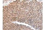 The image on the left is immunohistochemistry of paraffin-embedded Human lung cancer tissue using CSB-PA235670(ATF1 Antibody) at dilution 1/35, on the right is treated with synthetic peptide. (Original magnification: 