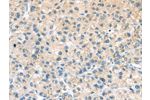 The image on the left is immunohistochemistry of paraffin-embedded Human liver cancer tissue using CSB-PA235900(ADRB3 Antibody) at dilution 1/20, on the right is treated with synthetic peptide. (Original magnification: 