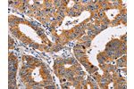 The image on the left is immunohistochemistry of paraffin-embedded Human gastic cancer tissue using CSB-PA235954(ADH1A Antibody) at dilution 1/25, on the right is treated with fusion protein. (Original magnification: 