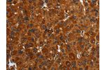 The image on the left is immunohistochemistry of paraffin-embedded Human liver cancer tissue using CSB-PA235961(ENTPD7 Antibody) at dilution 1/40, on the right is treated with fusion protein. (Original magnification: 