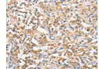 The image on the left is immunohistochemistry of paraffin-embedded Human thyroid cancer tissue using CSB-PA236190(ANKMY2 Antibody) at dilution 1/25, on the right is treated with fusion protein. (Original magnification: 