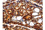 The image is immunohistochemistry of paraffin-embedded Human thyroid cancer tissue using CSB-PA236485(APLP1 Antibody) at dilution 1/25. (Original magnification: 