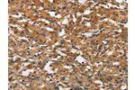 The image on the left is immunohistochemistry of paraffin-embedded Human thyroid cancer tissue using CSB-PA237032(BLK Antibody) at dilution 1/20, on the right is treated with fusion protein. (Original magnification: 