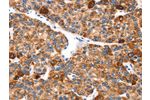 The image on the left is immunohistochemistry of paraffin-embedded Human liver cancer tissue using CSB-PA237202(EPO Antibody) at dilution 1/25, on the right is treated with synthetic peptide. (Original magnification: 