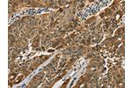 The image on the left is immunohistochemistry of paraffin-embedded Human ovarian cancer tissue using CSB-PA237699(CTSE Antibody) at dilution 1/50, on the right is treated with fusion protein. (Original magnification: 