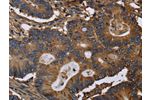 The image on the left is immunohistochemistry of paraffin-embedded Human colon cancer tissue using CSB-PA237744(FGB Antibody) at dilution 1/20, on the right is treated with fusion protein. (Original magnification: 
