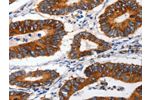 The image on the left is immunohistochemistry of paraffin-embedded Human colon cancer tissue using CSB-PA237804(CLDND1 Antibody) at dilution 1/60, on the right is treated with synthetic peptide. (Original magnification: 