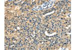 The image on the left is immunohistochemistry of paraffin-embedded Human breast cancer tissue using CSB-PA237947(DHCR24 Antibody) at dilution 1/40, on the right is treated with fusion protein. (Original magnification: 