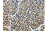 The image on the left is immunohistochemistry of paraffin-embedded Human liver cancer tissue using CSB-PA238135(ARHGEF3 Antibody) at dilution 1/25, on the right is treated with fusion protein. (Original magnification: 