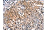 The image on the left is immunohistochemistry of paraffin-embedded Human gastic cancer tissue using CSB-PA239397(BFAR Antibody) at dilution 1/25, on the right is treated with synthetic peptide. (Original magnification: 