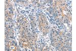 The image on the left is immunohistochemistry of paraffin-embedded Human gastic cancer tissue using CSB-PA239750(ARHGEF11 Antibody) at dilution 1/25, on the right is treated with synthetic peptide. (Original magnification: 