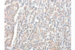 The image on the left is immunohistochemistry of paraffin-embedded Human breast cancer tissue using CSB-PA240615(ADA Antibody) at dilution 1/15, on the right is treated with fusion protein. (Original magnification: 