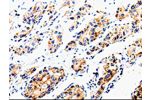 The image is immunohistochemistry of paraffin-embedded Human liver cancer tissue using CSB-PA241484(COX16 Antibody) at dilution 1/50. (Original magnification: 