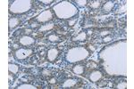 The image on the left is immunohistochemistry of paraffin-embedded Human thyroid cancer tissue using CSB-PA241758(EGFL7 Antibody) at dilution 1/20, on the right is treated with fusion protein. (Original magnification: 
