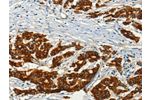 The image on the left is immunohistochemistry of paraffin-embedded Human colon cancer tissue using CSB-PA241921(ADCY3 Antibody) at dilution 1/50, on the right is treated with fusion protein. (Original magnification: 