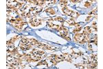 The image on the left is immunohistochemistry of paraffin-embedded Human thyroid cancer tissue using CSB-PA242652(DUSP19 Antibody) at dilution 1/30, on the right is treated with fusion protein. (Original magnification: 