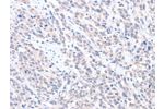 The image on the left is immunohistochemistry of paraffin-embedded Human esophagus cancer tissue using CSB-PA242662(ABLIM1 Antibody) at dilution 1/25, on the right is treated with fusion protein. (Original magnification: 