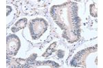 The image on the left is immunohistochemistry of paraffin-embedded Human colon cancer tissue using CSB-PA242845(APEX1 Antibody) at dilution 1/20, on the right is treated with fusion protein. (Original magnification: 