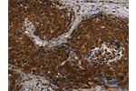The image on the left is immunohistochemistry of paraffin-embedded Human cervical cancer tissue using CSB-PA243120(CERS5 Antibody) at dilution 1/40, on the right is treated with synthetic peptide. (Original magnification: 