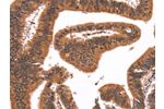 The image on the left is immunohistochemistry of paraffin-embedded Human colon cancer tissue using CSB-PA243625(FAIM Antibody) at dilution 1/25, on the right is treated with synthetic peptide. (Original magnification: 