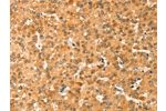 The image on the left is immunohistochemistry of paraffin-embedded Human liver cancer tissue using CSB-PA243656(COLEC11 Antibody) at dilution 1/20, on the right is treated with fusion protein. (Original magnification: 