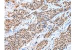 The image on the left is immunohistochemistry of paraffin-embedded Human breast cancer tissue using CSB-PA243683(CTBP1 Antibody) at dilution 1/30, on the right is treated with synthetic peptide. (Original magnification: &times;200)