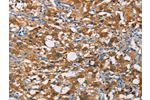 The image on the left is immunohistochemistry of paraffin-embedded Human thyroid cancer tissue using CSB-PA243691(CRTAM Antibody) at dilution 1/60, on the right is treated with fusion protein. (Original magnification: 