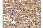 The image on the left is immunohistochemistry of paraffin-embedded Human thyroid cancer tissue using CSB-PA243767(EIF4G1 Antibody) at dilution 1/30, on the right is treated with synthetic peptide. (Original magnification: 