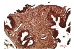 Immunohistochemical analysis of paraffin-embedded Human Prostate Carcinoma Tissue using ATM Rabbit pAb diluted at 1:200.
