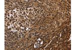 The image on the left is immunohistochemistry of paraffin-embedded Human cervical cancer tissue using CSB-PA244133(DCP1A Antibody) at dilution 1/50, on the right is treated with fusion protein. (Original magnification: 