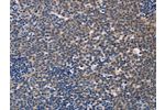 The image on the left is immunohistochemistry of paraffin-embedded Human Lymphoma tissue using CSB-PA244343(CCR6 Antibody) at dilution 1/50, on the right is treated with synthetic peptide. (Original magnification: 