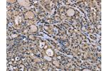 The image on the left is immunohistochemistry of paraffin-embedded Human thyroid cancer tissue using CSB-PA244606(DYNLL1 Antibody) at dilution 1/30, on the right is treated with fusion protein. (Original magnification: 