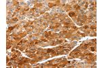 The image on the left is immunohistochemistry of paraffin-embedded Human liver cancer tissue using CSB-PA244699(CIDEC Antibody) at dilution 1/50, on the right is treated with fusion protein. (Original magnification: 