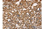 The image on the left is immunohistochemistry of paraffin-embedded Human thyroid cancer tissue using CSB-PA244825(CDC25A Antibody) at dilution 1/60, on the right is treated with synthetic peptide. (Original magnification: 