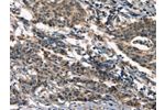 The image on the left is immunohistochemistry of paraffin-embedded Human gastic cancer tissue using CSB-PA245088(DEFA5 Antibody) at dilution 1/15, on the right is treated with synthetic peptide. (Original magnification: 
