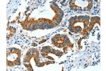 The image on the left is immunohistochemistry of paraffin-embedded Human colon cancer tissue using CSB-PA245428(BAG3 Antibody) at dilution 1/25, on the right is treated with fusion protein. (Original magnification: 