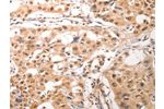 The image on the left is immunohistochemistry of paraffin-embedded Human lung cancer tissue using CSB-PA245457(CDC6 Antibody) at dilution 1/25, on the right is treated with synthetic peptide. (Original magnification: 