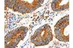The image on the left is immunohistochemistry of paraffin-embedded Human colon cancer tissue using CSB-PA245851(GDF6 Antibody) at dilution 1/20, on the right is treated with synthetic peptide. (Original magnification: 
