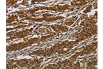 The image on the left is immunohistochemistry of paraffin-embedded Human gastic cancer tissue using CSB-PA245950(GATA5 Antibody) at dilution 1/50, on the right is treated with synthetic peptide. (Original magnification: 